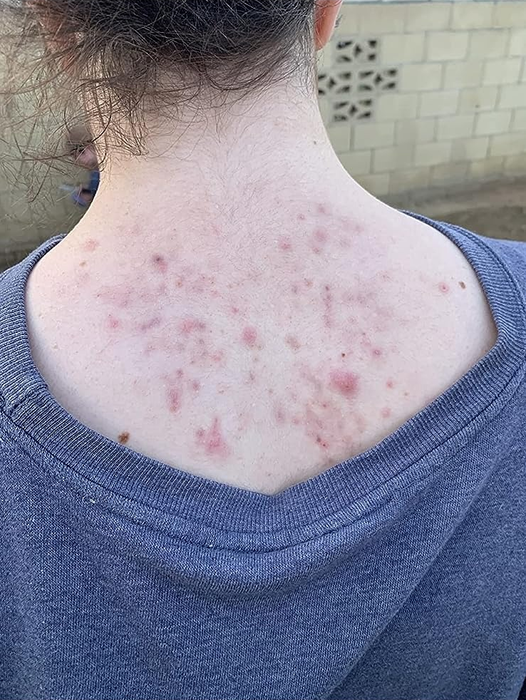 A reviewer shows their back acne before using the wash.
