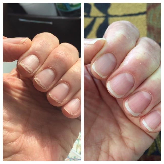 A before-and-after comparison of a reviewer who used the oil, showing a noticeable reduction in nail breakage.