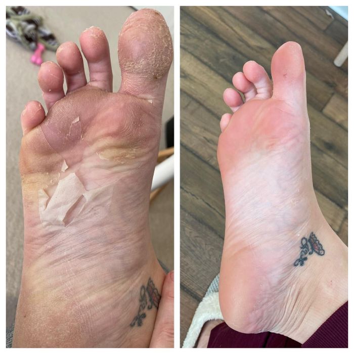 A foot peeling after using the mask, with the same foot looking much softer afterward.