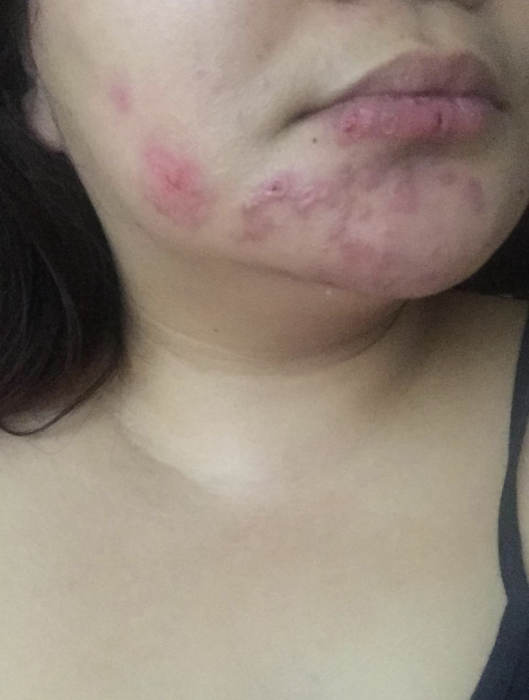 A person with prominent scars on their chin caused by shingles.