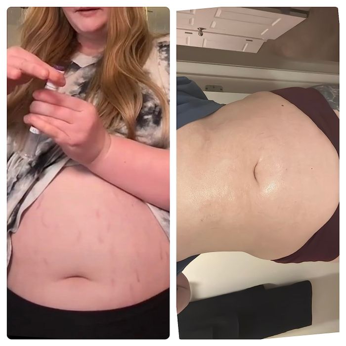 A before-and-after comparison from a reviewer showing how Bio-Oil helped reduce the appearance of their stretch marks.