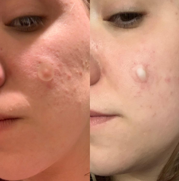 A before-and-after shot showing the pus drawn out from the pimple where a patch was applied, demonstrating its effectiveness.