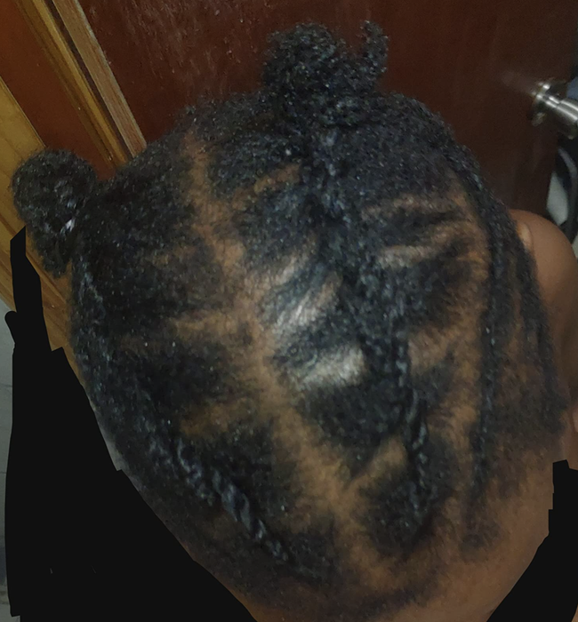 A reader's scalp appearing fuller after using this shampoo