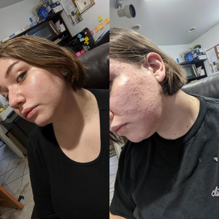 Before-and-after comparison of a reviewer using the gel