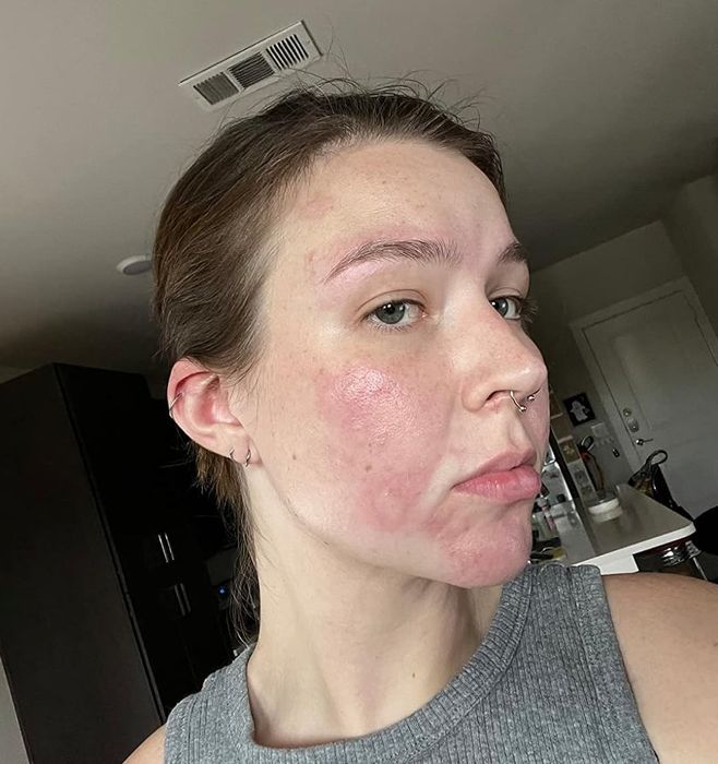 Reviewer's skin prior to using the serum