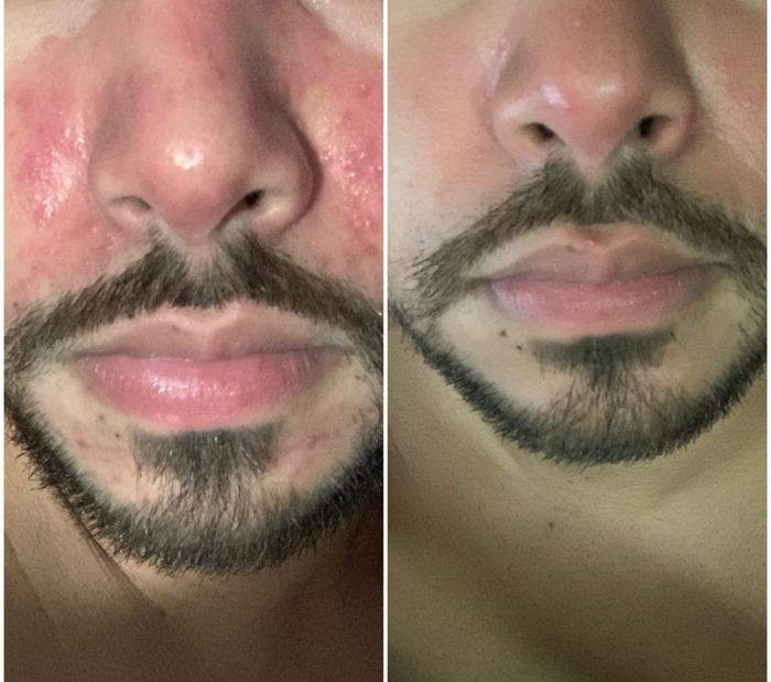 A close-up before-and-after comparison of a reviewer’s nose and mouth, showing visible skin improvement.