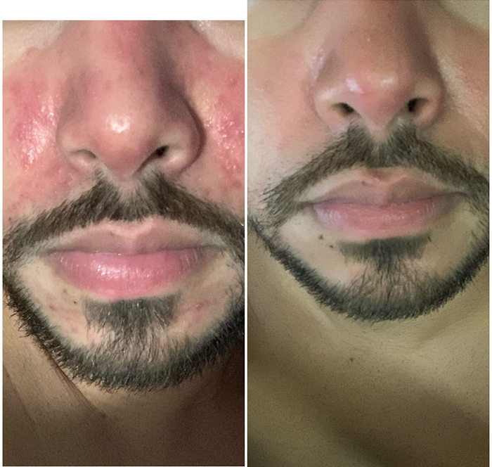 A reviewer with rosacea on their cheeks and nose shows visibly calmer skin after applying the sunscreen, highlighting its soothing properties.