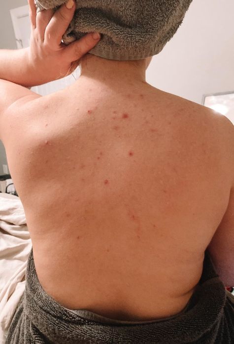 Before using the spray: reviewer's back