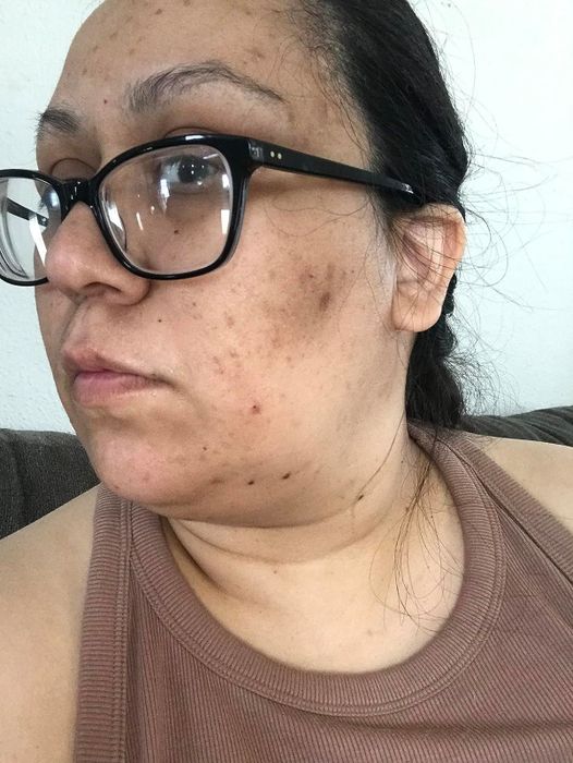 Reviewer's skin prior to using the serum