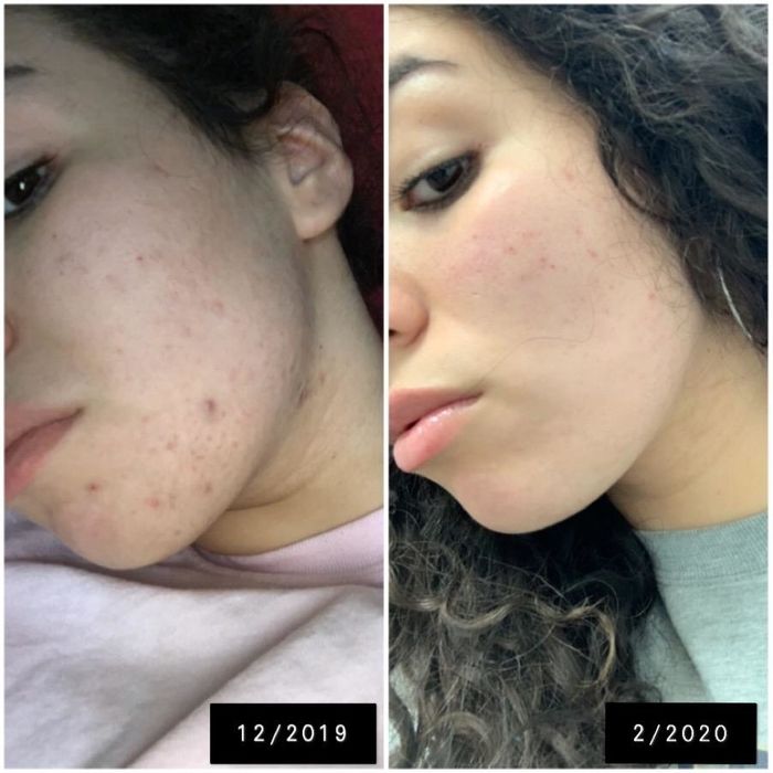 Before and after photo of the reviewer's skin after using the cleansing pads for two months