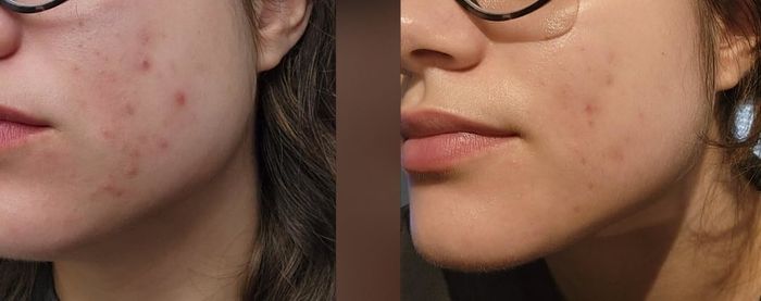 Reviewer's skin before and after using the pillowcase
