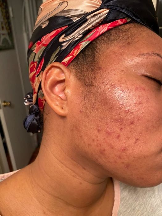 Before using the exfoliant: reviewer's skin