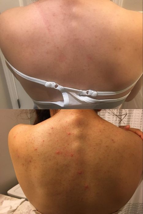 Reviewer's back before and after using the wash