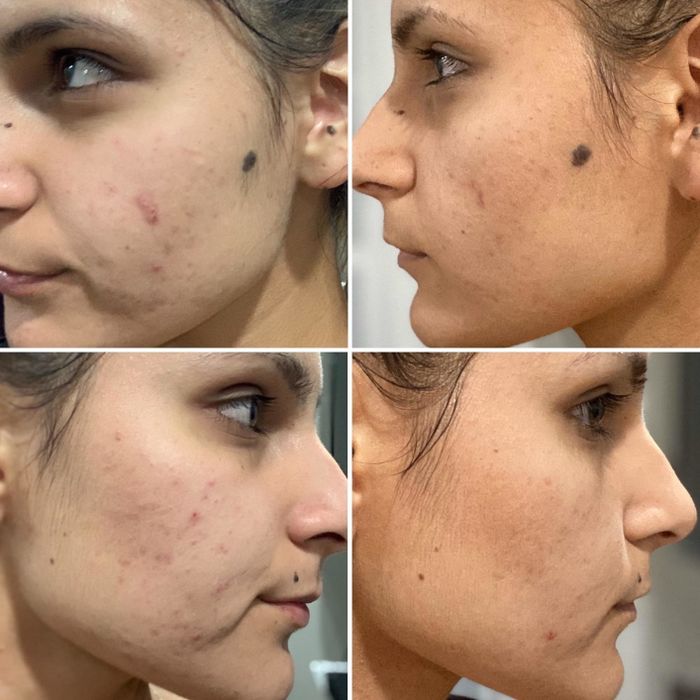 Reviewer's skin progression during the mask treatment