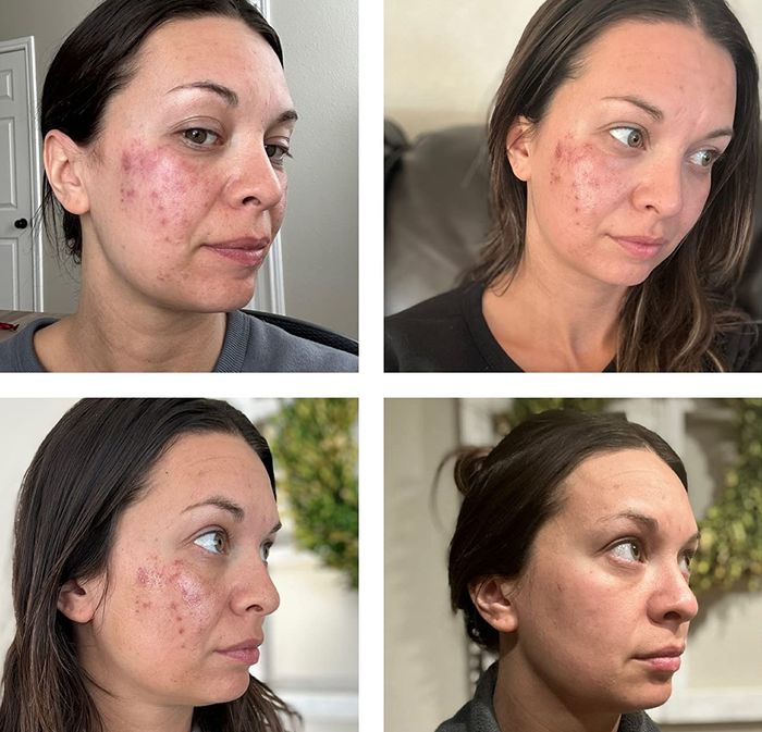 Reviewer's skin progression during the peel treatment