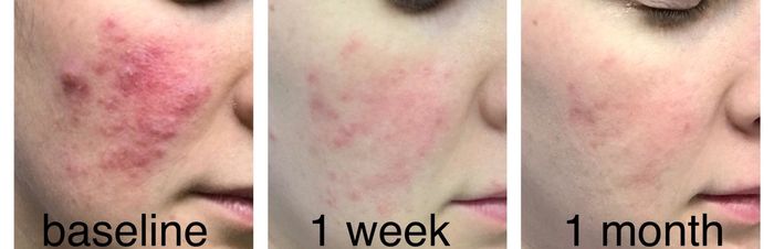 Reviewer's skin changes over the span of a month