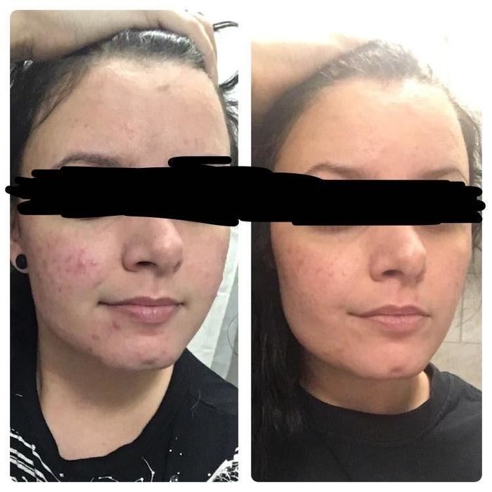Before-and-after review from a customer using the acne wash