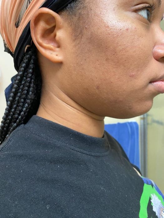 After using the exfoliant: reviewer's skin