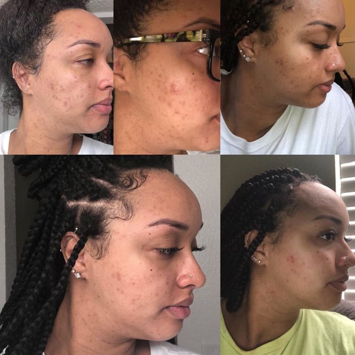 Reviewer demonstrating the progression of skincare results on their face