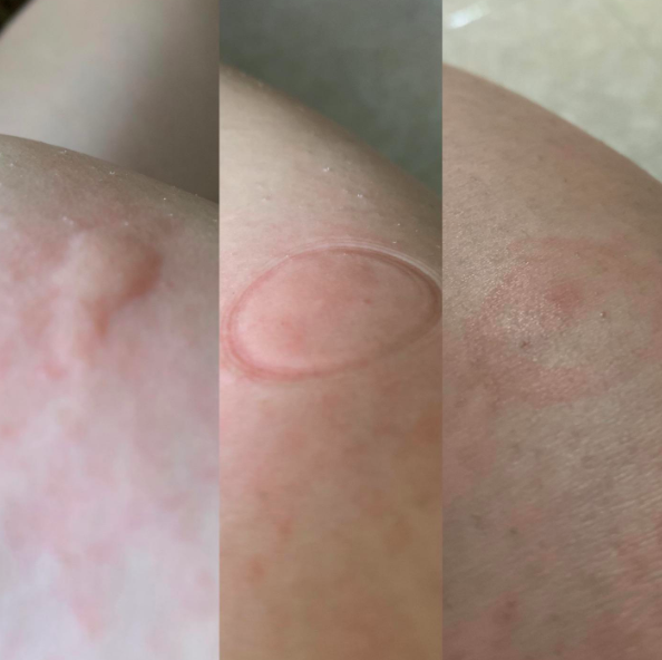 Reviewer's before-and-after photo showing a bug bite's swelling reduced after using the product