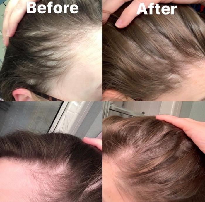 before and after showing a reviewer's hair growth results