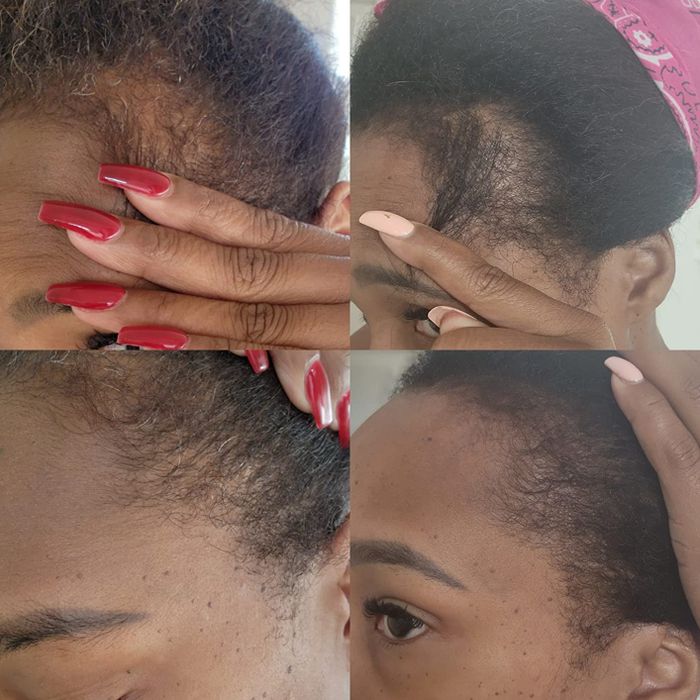 A before-and-after review showcasing hairline regrowth results.