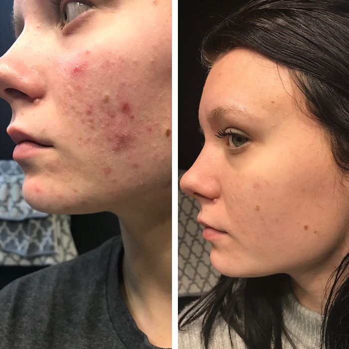 Reviewer demonstrating the visible improvements after using the CeraVe hydrating cleanser.