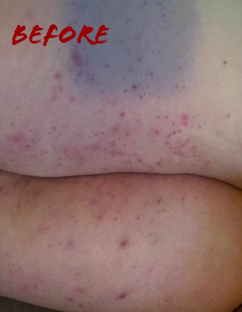 A reviewer's legs displaying razor burn, ingrown hairs, and irritated skin