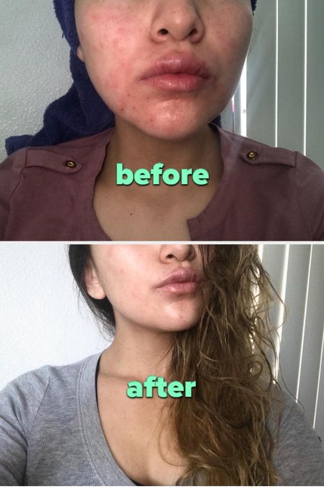 A comparison of a reviewer's skin before and after using the product.