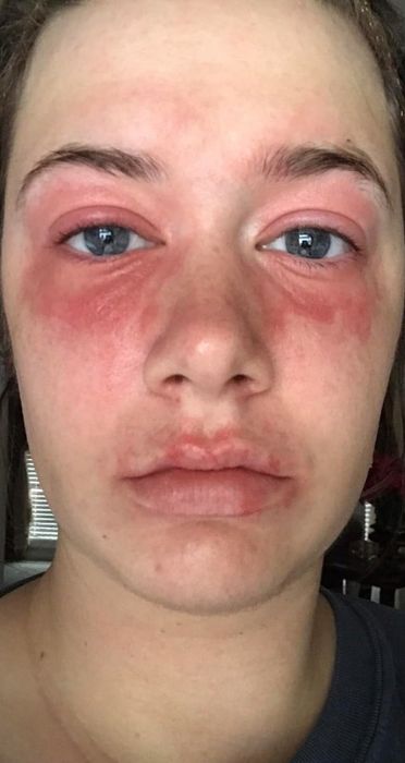 A close-up image showing a person's face with redness and swelling around the eyes and lips, suggesting an allergic reaction or skin irritation. The focus is solely on the individual's face.
