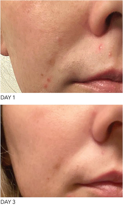 A detailed close-up of a person's face demonstrates noticeable skin enhancement from day 1 to day 3, with a significant reduction in blemishes by the third day.