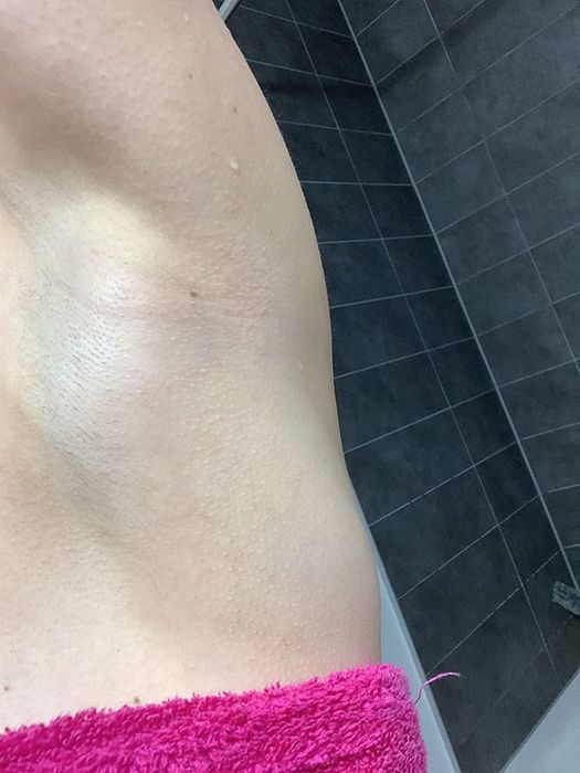 The same reviewer after applying the cream, showing their rash completely cleared up.
