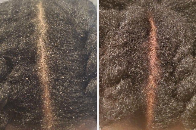 Transformation images showing a reviewer's scalp with dandruff before treatment and the improved condition after.