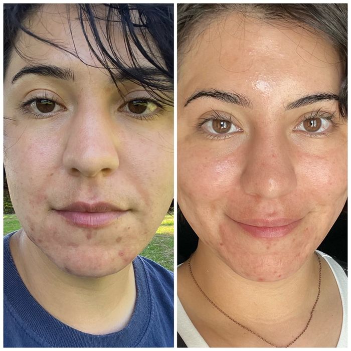 Two close-up photos of a person's face are placed side by side. The left photo displays her with acne, while the right photo shows her skin after treatment. The individuals' names are not provided.