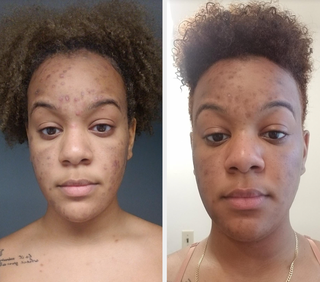 Reviewer's before photo showing dark scars and after photo with noticeable fading after using the oil.