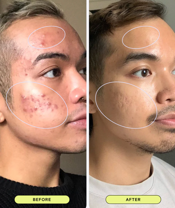 A side-by-side visual of a person's skin before and after treatment, highlighting noticeable improvements