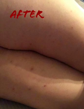 The same legs now smoother, with reduced redness and only a few faint dark marks remaining