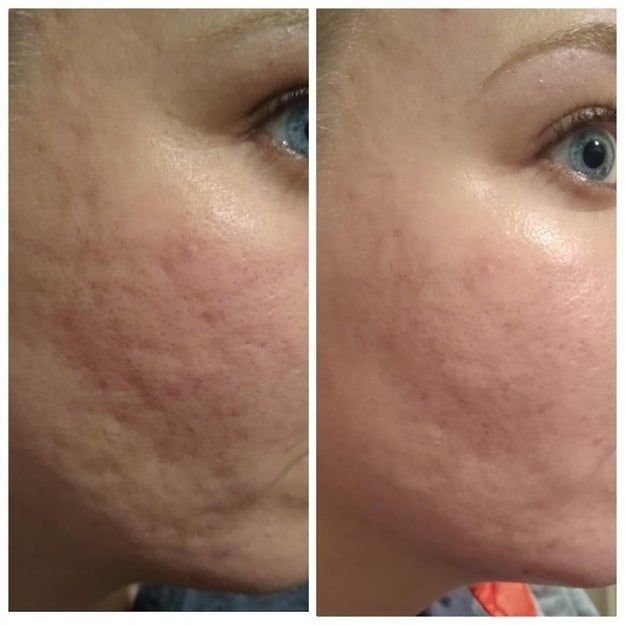Two close-up images of a person's cheek, placed side by side, demonstrate a noticeable enhancement in skin texture following acne treatment.