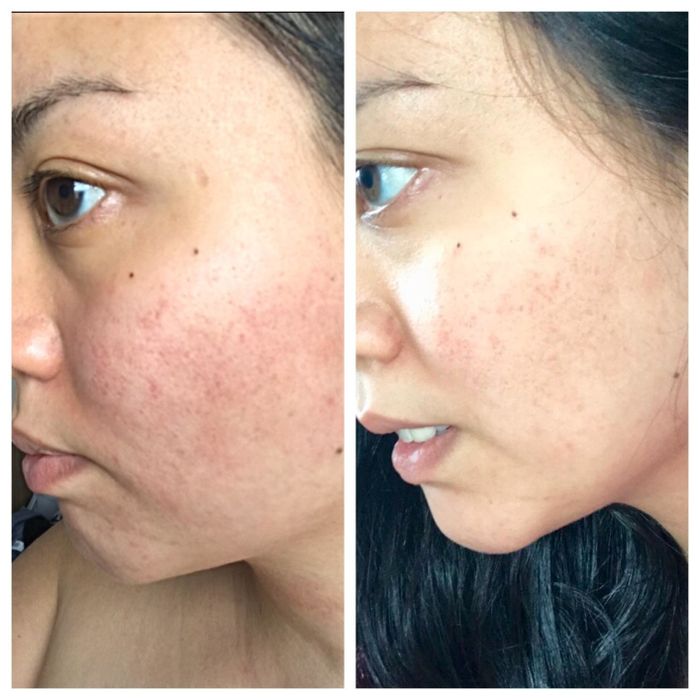 Side-by-side close-up images of a person's cheek demonstrate a noticeable reduction in redness and a smoother complexion. The individual's name is not disclosed.