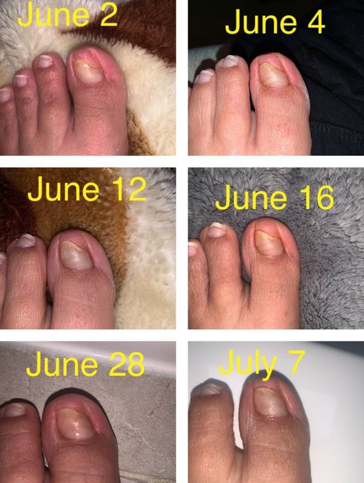 Visual evidence of a reviewer's toenail transformation, demonstrating the effectiveness of the pen in eliminating toenail fungus.