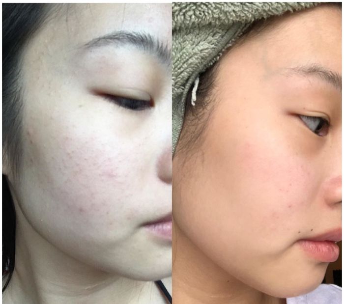 A comparison showing a reviewer's skin with red bumps in the 'before' image and clear, smooth skin in the 'after' photo.