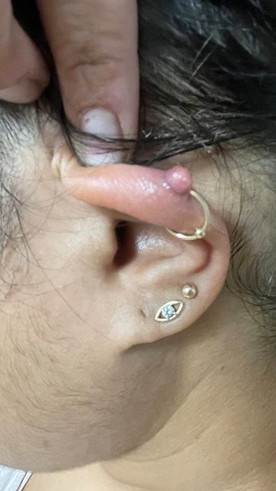 A reviewer's ear displaying a keloid bump near their piercing.