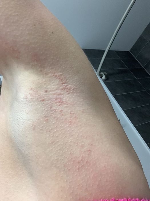 A reviewer shows a rash/eczema around their armpit area before using the cream.
