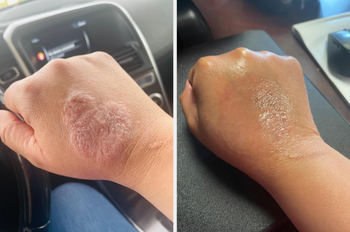 A reviewer's hand showing a significant eczema patch before it was completely healed.