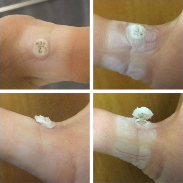 A reviewer's transformation, demonstrating how the pads effectively removed a wart from their finger.