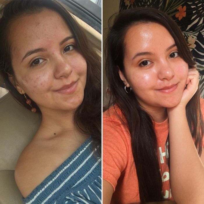a reviewer's before and after photos, showing the improvement in their facial acne