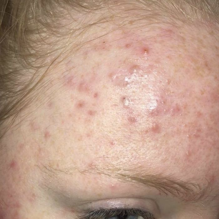 A customer’s review photo showing the texture on their forehead prior to using the exfoliant.