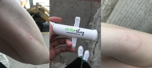 A Mytour editor's arm with a bite, holding the suction tool, followed by an after photo showing the reduced swelling on the editor's arm.
