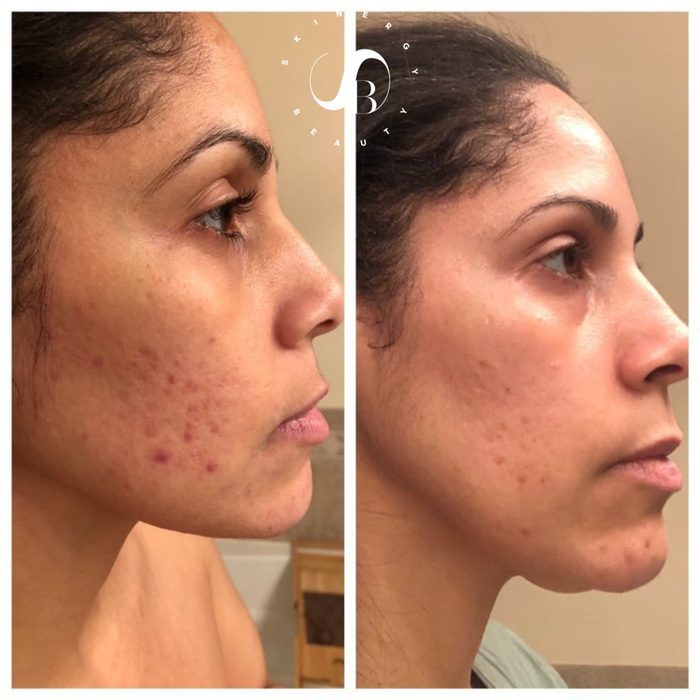 A customer’s before-and-after photo showing clear skin after using the serum