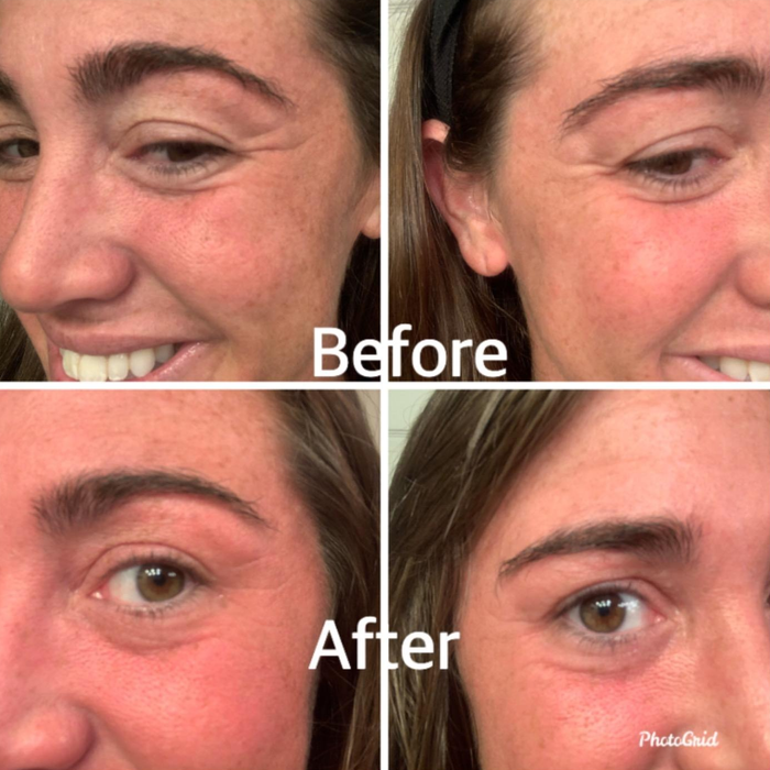 A close-up before and after shot of a reviewer’s eye area, showing the noticeable effects of the hyaluronic acid.
